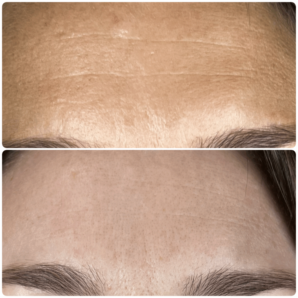 Zapobieganie pierwszym zmarszczkom dzięki Needle Shaping