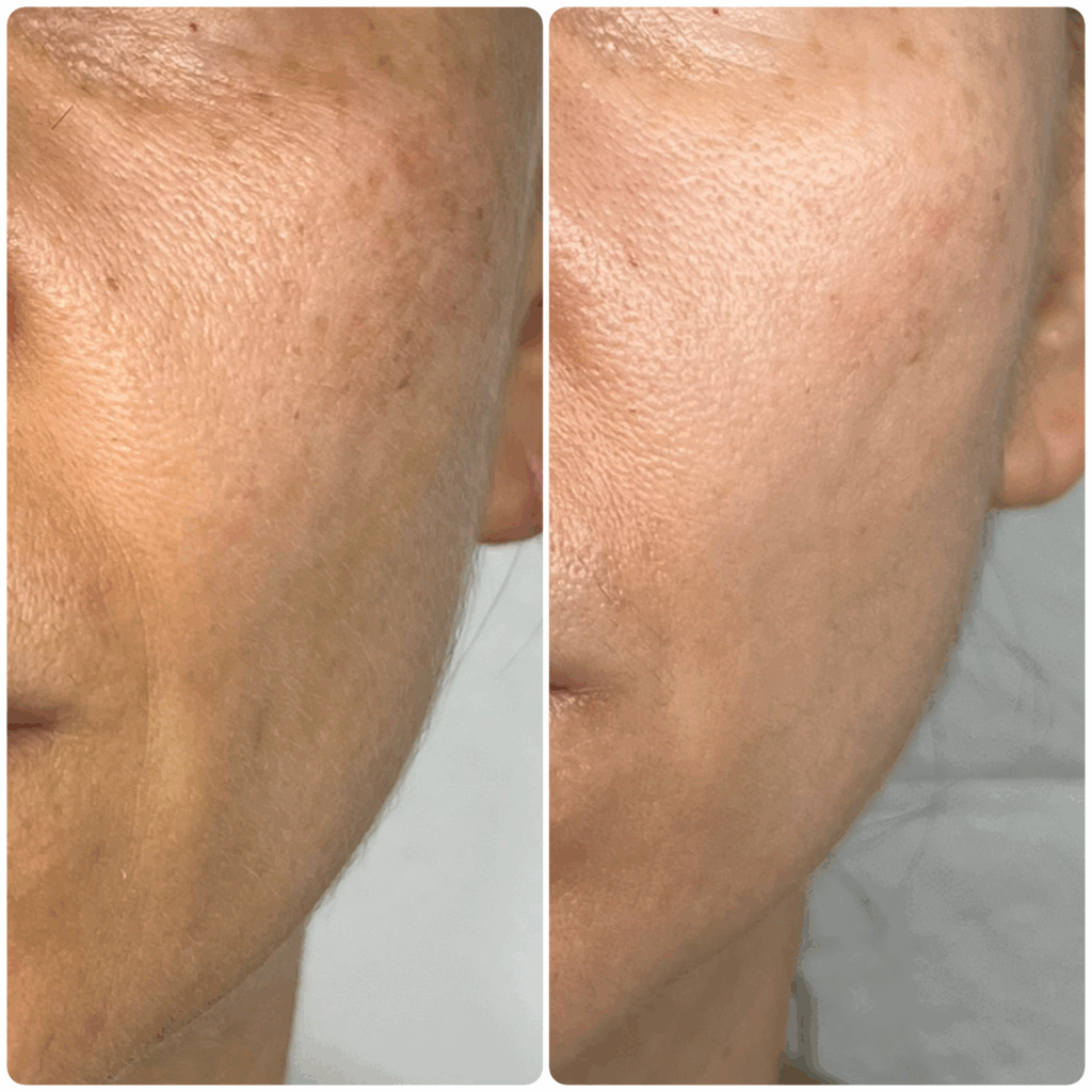 Poprawa owalu twarzy po zabiegu Needle Shaping