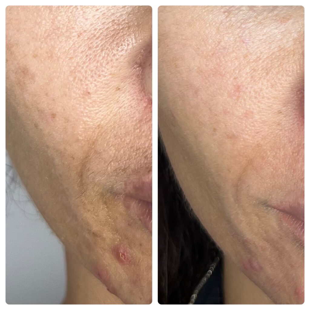 Poprawa owalu twarzy po zabiegu Needle Shaping