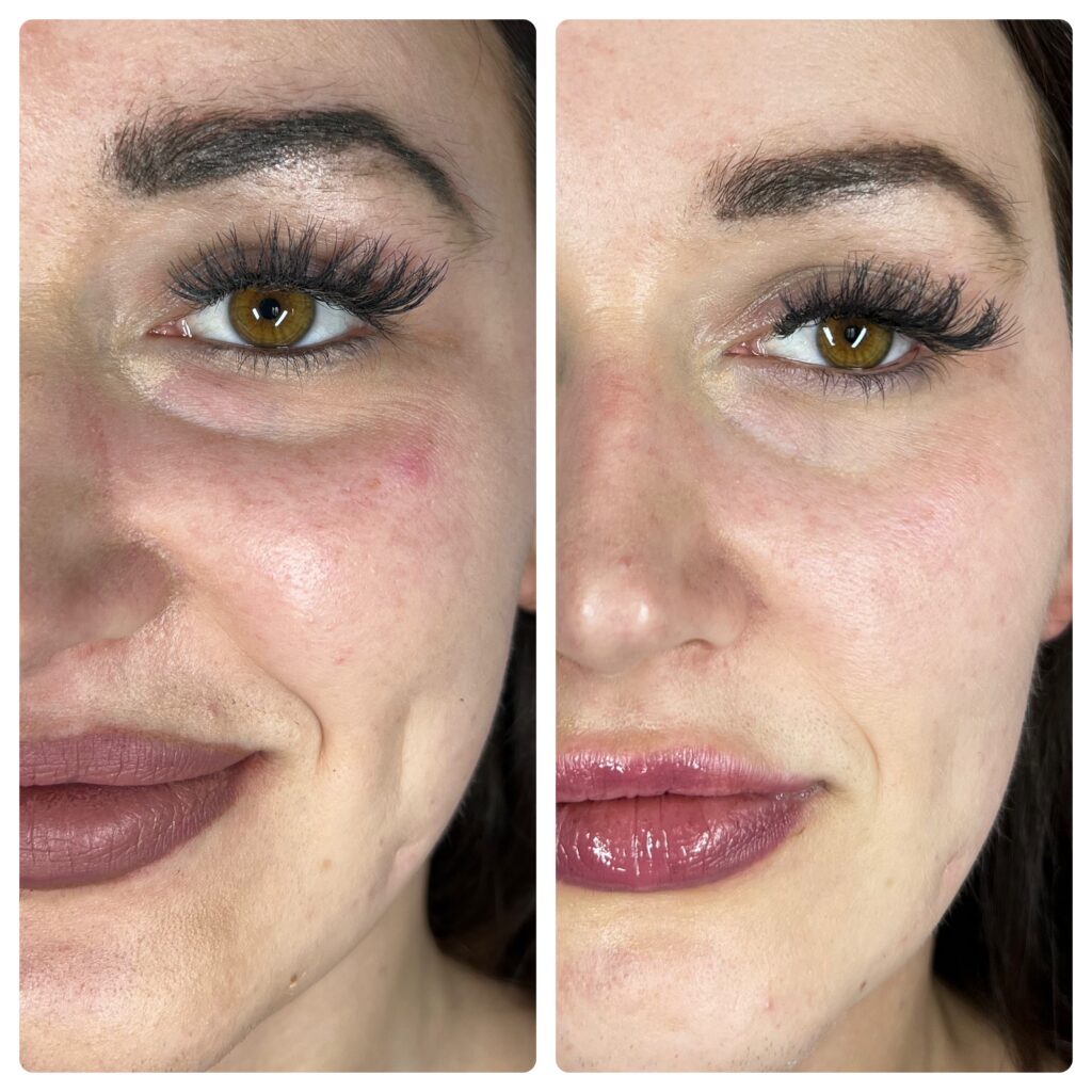 Zmniejszenie porów dzięki Needle Shaping