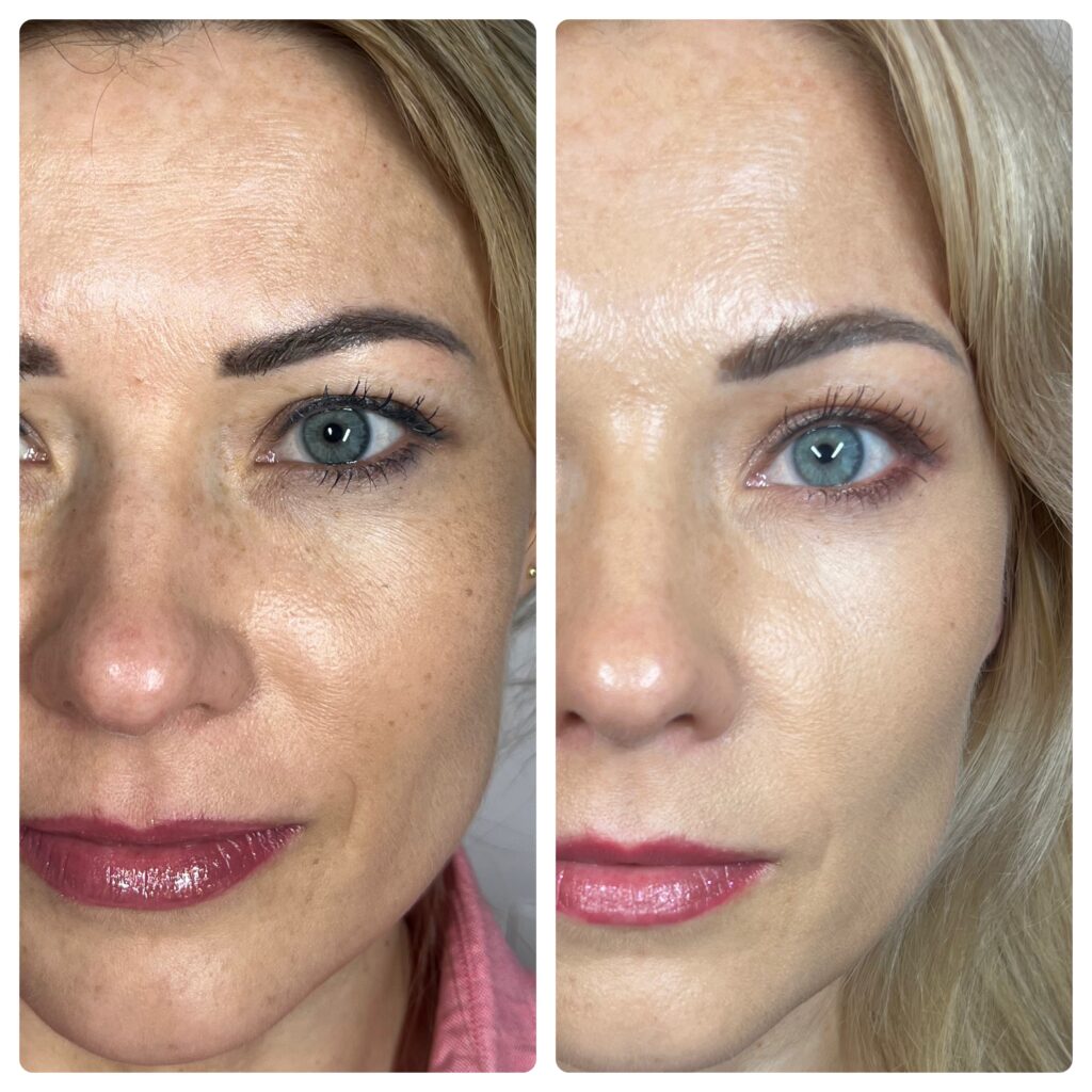 Redukcja przebarwień skóry metodą Needle Shaping